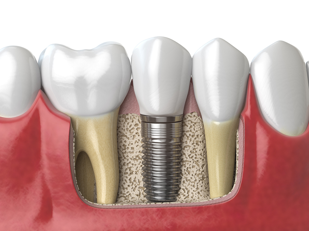 How Much Do Dental Implants Cost in Michigan?