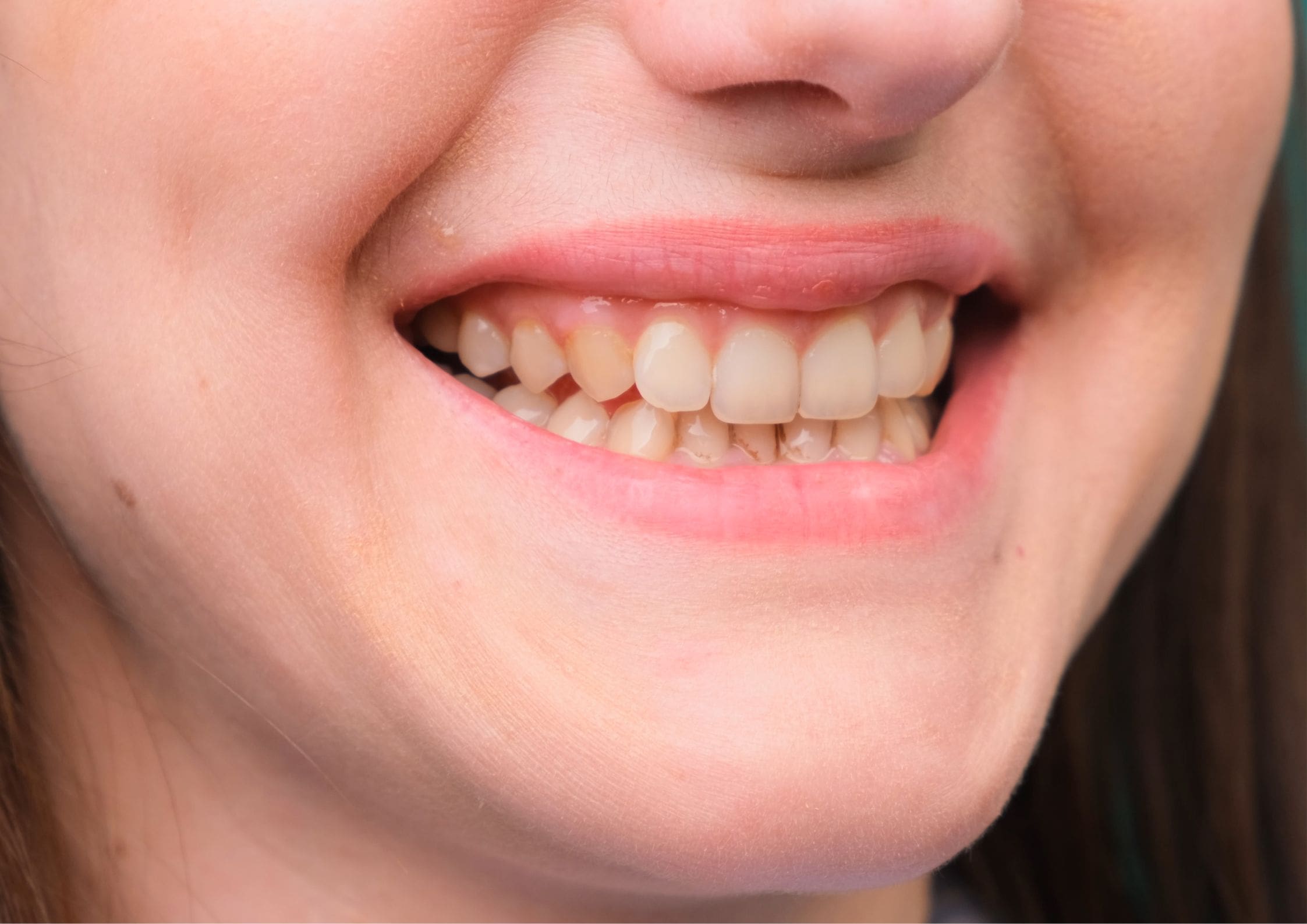 Are Teeth Naturally Yellow? [A Board Certified Dentist Explains]