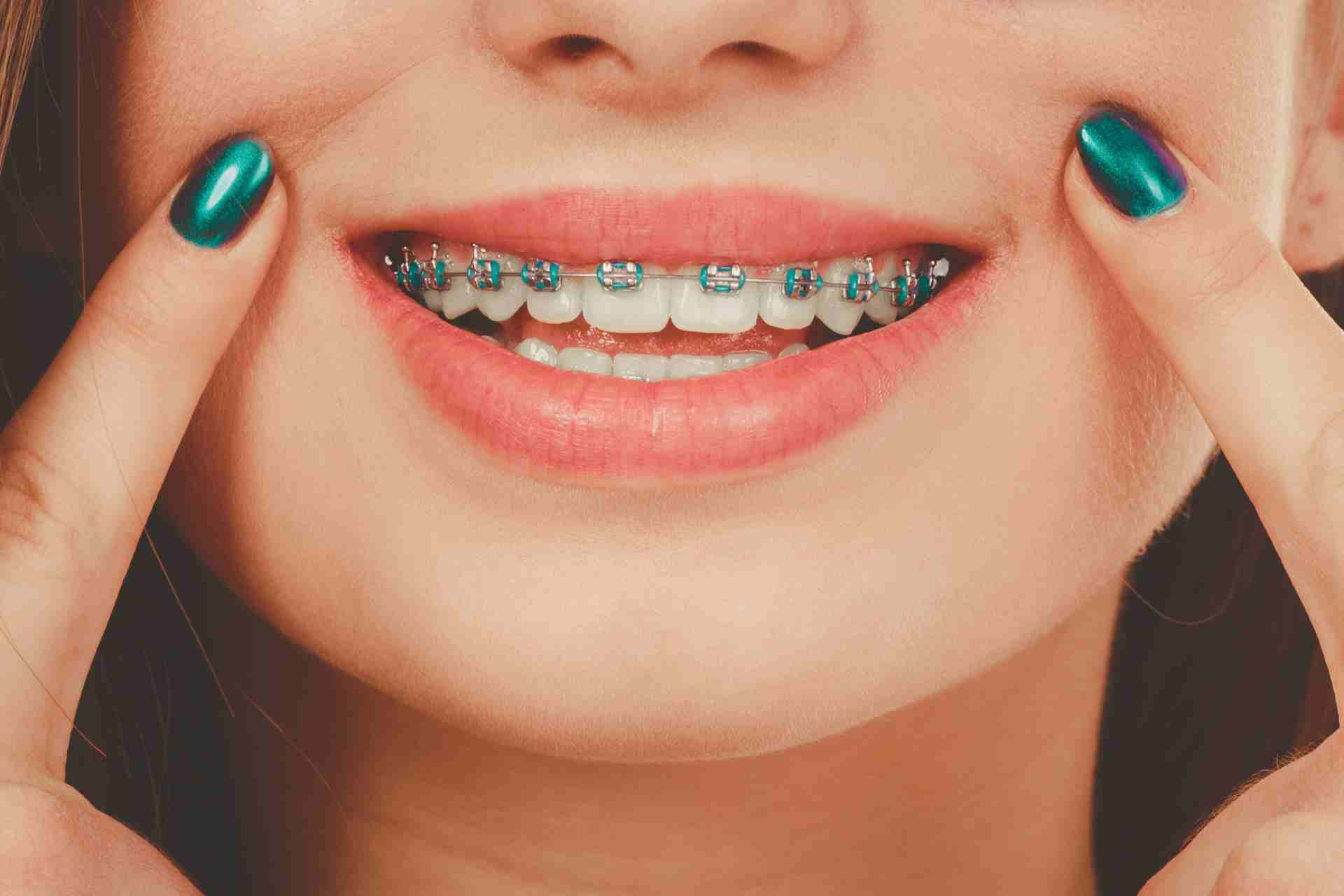 What Can You Eat with Braces?