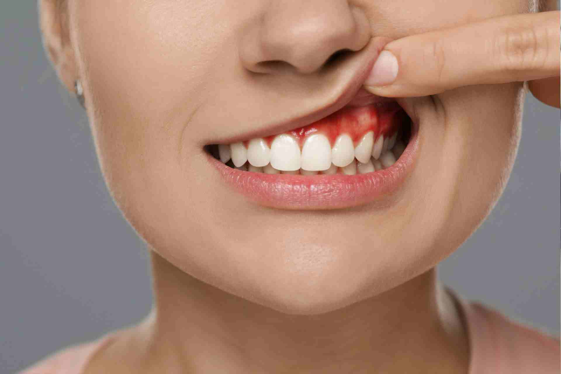 Ways to Get Rid of Gingivitis